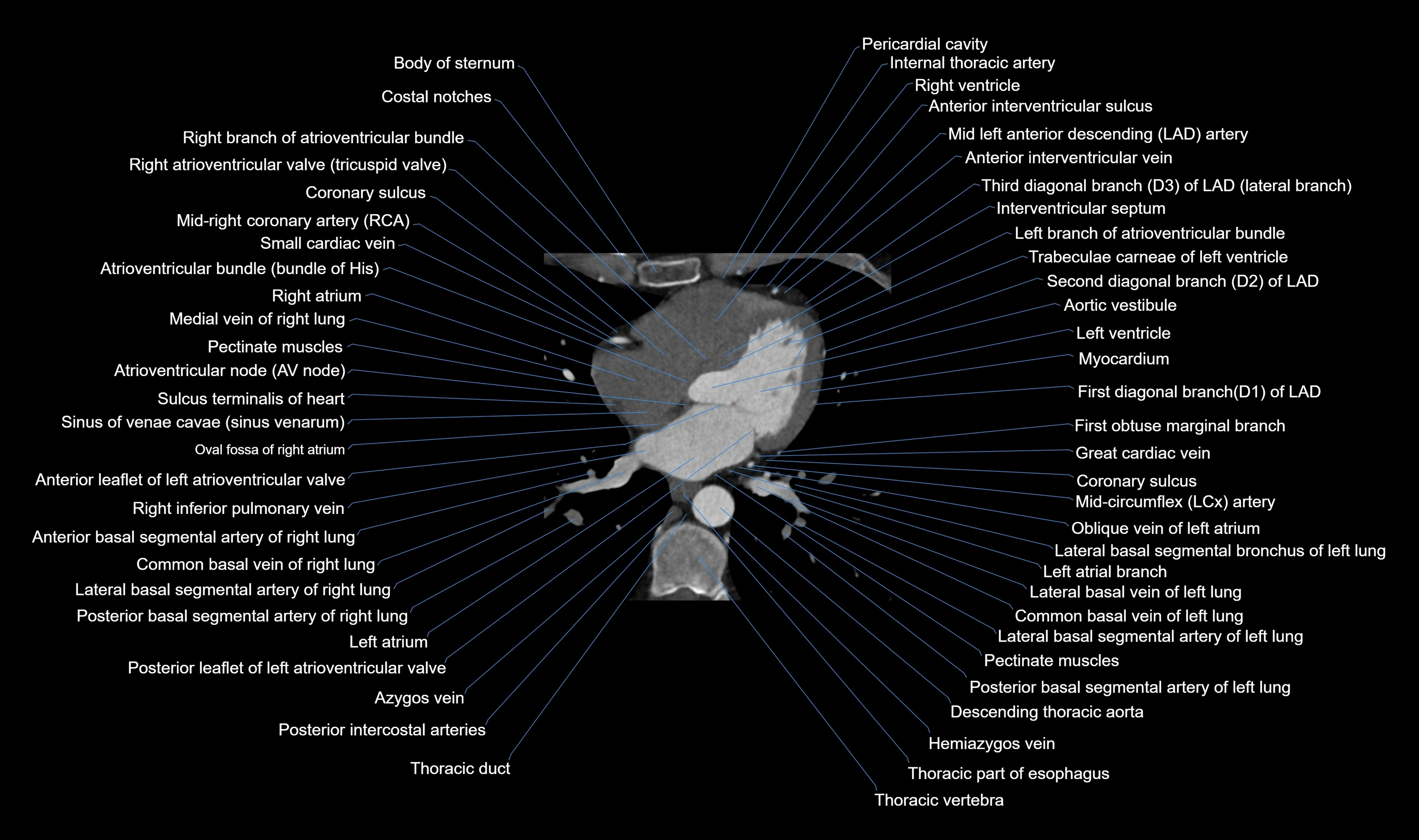 CT heart (coronary angiogram) axial view cross sectional anatomy labelled radiology image-00037.webp